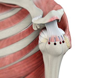 Arthroscopic Rotator Cuff Repair