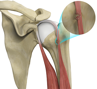 Bicep Tendon Rupture