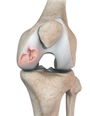 Chondral (Articular Cartilage Defects)