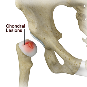 Chondral Lesions