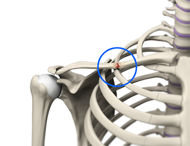 Clavicle Fracture 