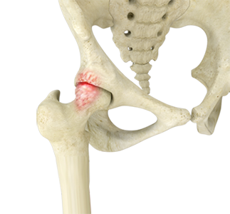 Femoroacetabular Impingement