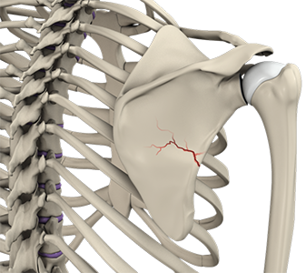 Fracture of the Shoulder Blade 