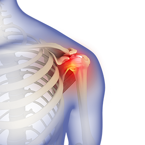 Treating Frozen Shoulder & Range-of-Motion Shoulder Injuries — RS Medical