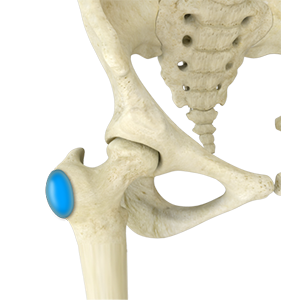 Greater Trochanteric Bursitis