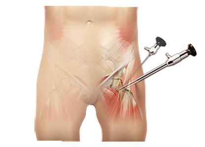 Hip Arthroscopy