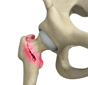 Hip Fracture