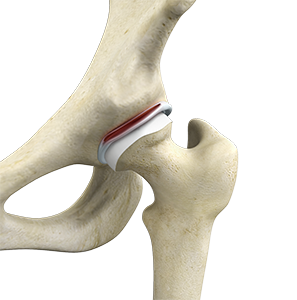Hip Labral Tear