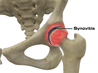 Hip Synovitis