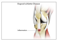 Osteochondritis Dissecans