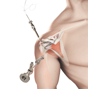 Shoulder Arthroscopy