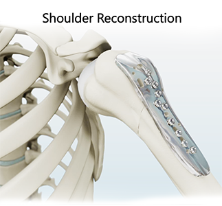 Shoulder Reconstruction
