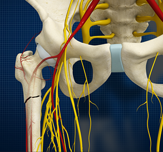 Subtrochanteric Hip Fracture